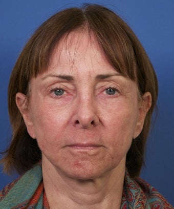 Sculptra Facial Contouring Injections before 1875409