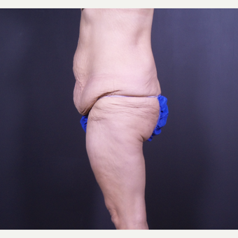 35-44 year old woman treated with Body Lift before 3585754
