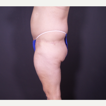 35-44 year old woman treated with Body Lift after 3585754