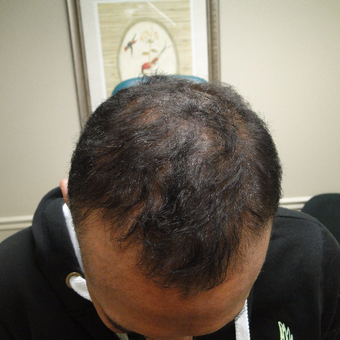 55-64 year old man treated with PRP for Hair Loss after 2732156