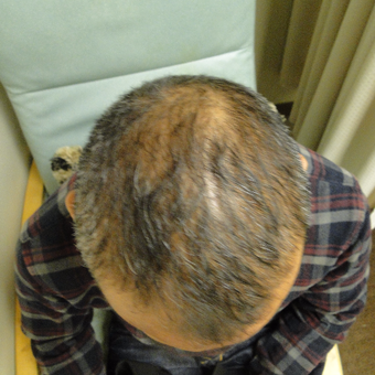 55-64 year old man treated with PRP for Hair Loss before 2732156