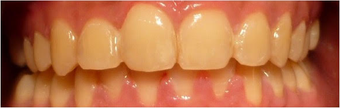 18-24 year old woman treated with Dental Braces after 3376308