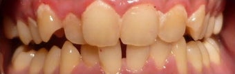 18-24 year old woman treated with Dental Braces before 3376308