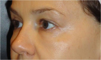 Restylane after 686377
