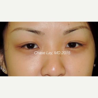 25-34 year old woman treated with Asian Eyelid Surgery before 1748632