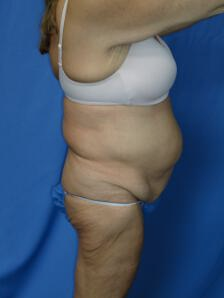 Circumferential Tuck 863779