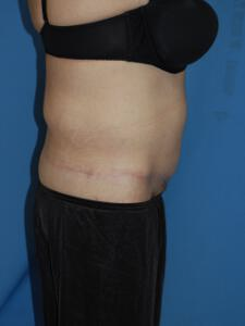 Circumferential Tuck 863779