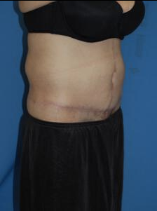 Circumferential Tuck after 863779