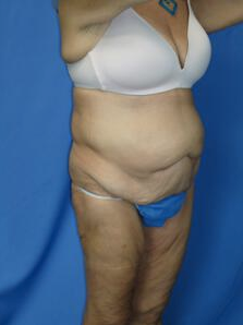Circumferential Tuck before 863779
