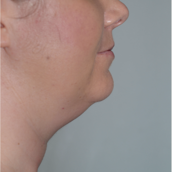 36 year old woman treated with CoolSculpting before 2841331