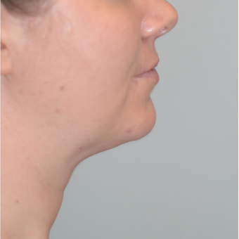 36 year old woman treated with CoolSculpting after 2841331