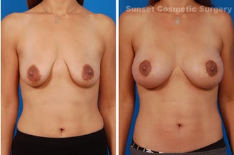 Benelli Mastopexy and Nipple Enhancement before 902718