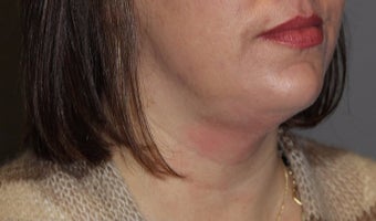35-44 year old woman treated with Kybella after 3147381