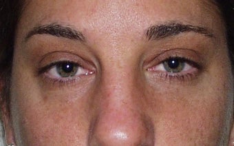 Eyelid Surgery after 228412