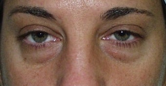 Eyelid Surgery before 228412