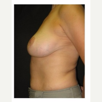 45-54 year old woman treated with Breast Lift after 3175689