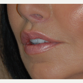 45-54 year old woman treated with Lip Lift 1800293