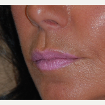 45-54 year old woman treated with Lip Lift 1800293