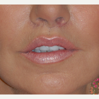 45-54 year old woman treated with Lip Lift after 1800293