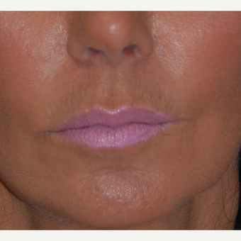 45-54 year old woman treated with Lip Lift before 1800293