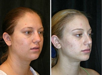 18-24 year old woman treated with Brow Lift before 3225555