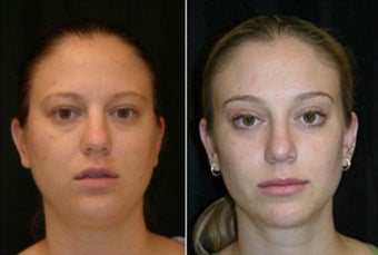 18-24 year old woman treated with Brow Lift after 3225555