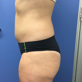 25-34 year old woman treated with Liposuction before 3415623