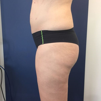 25-34 year old woman treated with Liposuction after 3415623