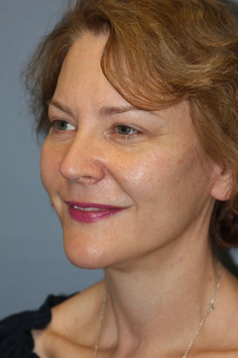 LiteLift™, Blepharoplasty, Brow Lift on 49-year-old Woman 1235653