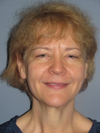 LiteLift™, Blepharoplasty, Brow Lift on 49-year-old Woman before 1235653