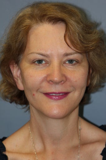 LiteLift™, Blepharoplasty, Brow Lift on 49-year-old Woman after 1235653