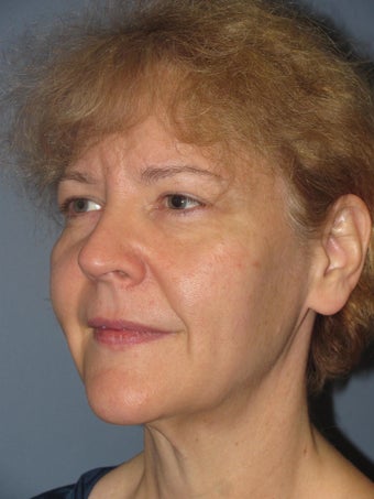 LiteLift™, Blepharoplasty, Brow Lift on 49-year-old Woman 1235653