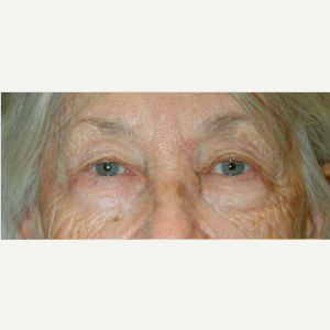 Mohs Surgery after 3711135