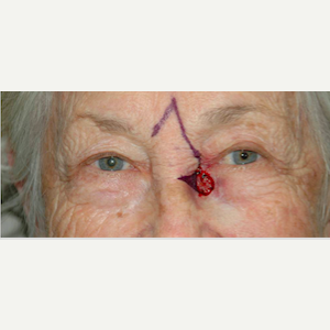 Mohs Surgery before 3711135