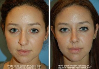 Rhinoplasty before 220745