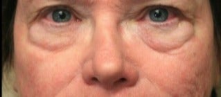 65-74 year old woman treated with Eye Bags Treatment before 3046882