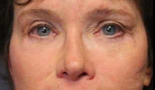 65-74 year old woman treated with Eye Bags Treatment after 3046882