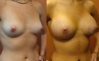 Breast Implants before 974270
