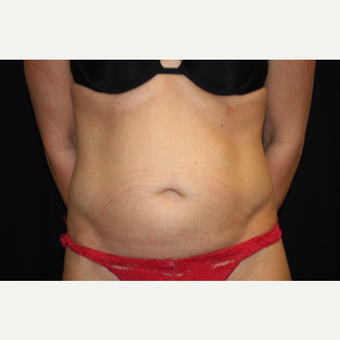 35-44 year old woman treated with Tummy Tuck before 3299449