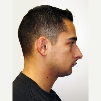 25-34 year old man treated with Orthognathic Surgery before 1667474