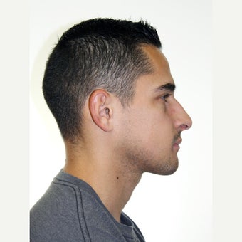 25-34 year old man treated with Orthognathic Surgery after 1667474