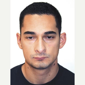 25-34 year old man treated with Orthognathic Surgery 1667474