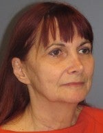 65-74 year old woman treated with Neck Lift before 3103870