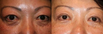 Upper and Lower Eyelid Surgery before 1243716