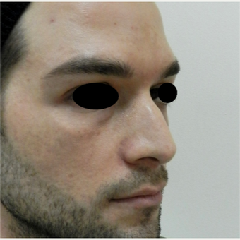 25-34 year old man treated with Rhinoplasty before 3642799