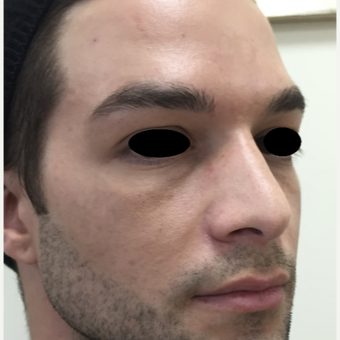 25-34 year old man treated with Rhinoplasty after 3642799