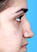 27 yo female treated for saddle nose deformity and hollow eyes before 1484302