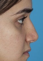 27 yo female treated for saddle nose deformity and hollow eyes after 1484302