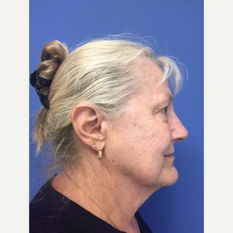65-74 year old woman treated with Mini Lift before 3684489
