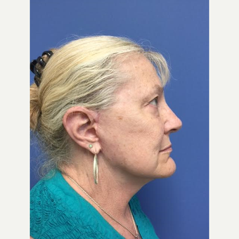 65-74 year old woman treated with Mini Lift after 3684489